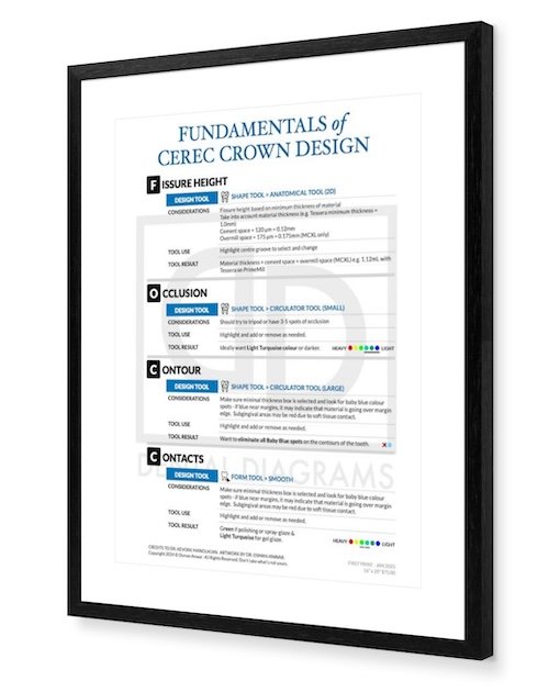 Fundamentals of Cerec Software Crown Design Poster
