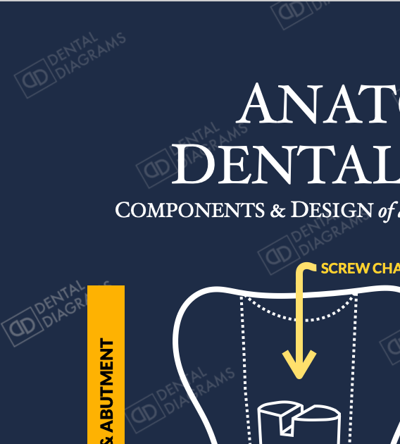 Anatomy of Dental Implant (Patient Education) 16" x 20" Poster