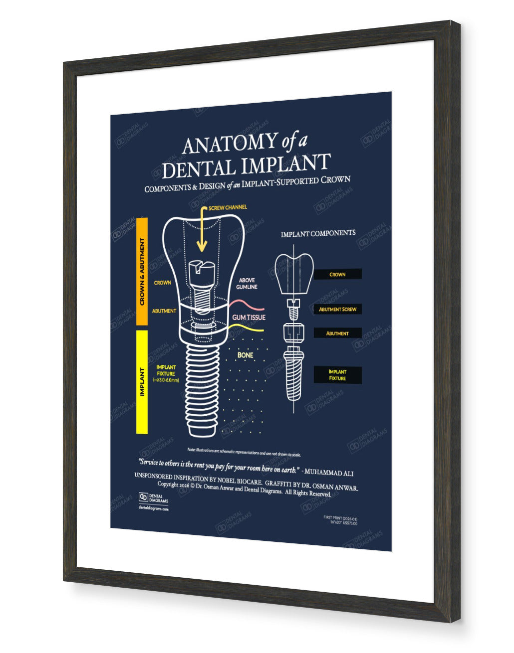 Anatomy of Dental Implant (Patient Education) 16" x 20" Poster