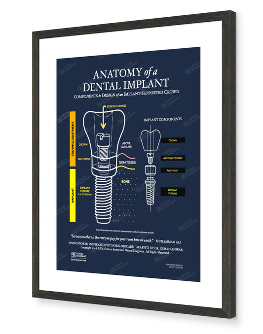 Anatomy of Dental Implant (Patient Education) 16" x 20" Poster