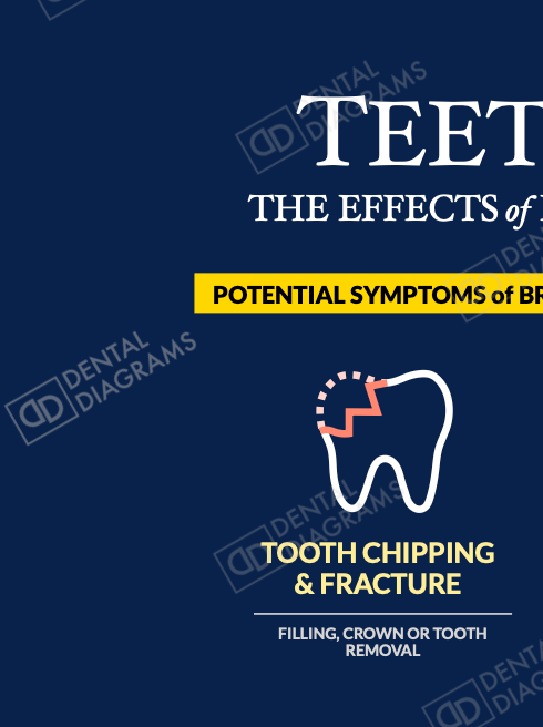 Teeth Grinding (Patient Education) 16" x 20" Poster