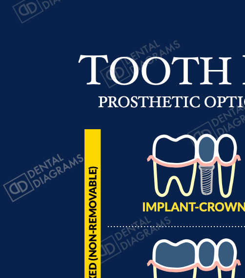 Tooth Replacement (Patient Education) 16" x 20" Poster